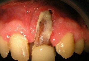 Osteomielite segundo o lume de dentes