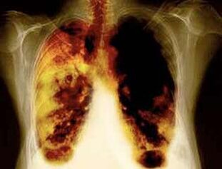 Lesións pulmonares ao usar nicotina